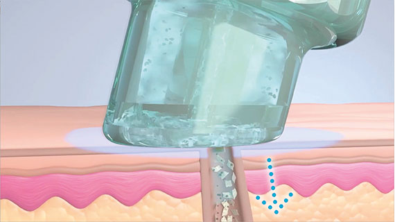 hydrafacial schritt2