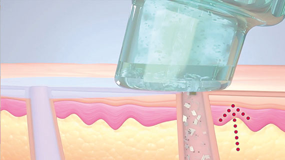 hydrafacial schritt3