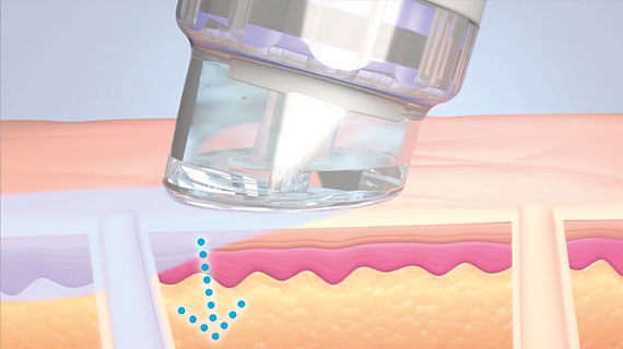 hydrafacial schritt4